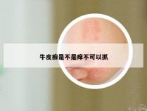 牛皮癣是不是痒不可以抓