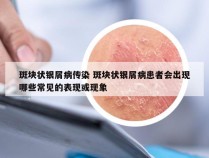 斑块状银屑病传染 斑块状银屑病患者会出现哪些常见的表现或现象