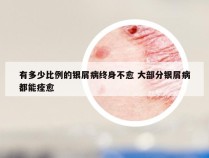 有多少比例的银屑病终身不愈 大部分银屑病都能痊愈