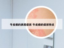 牛皮癣的表现症状 牛皮癣的症状特点