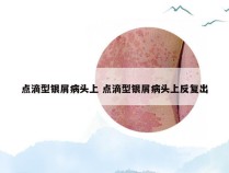 点滴型银屑病头上 点滴型银屑病头上反复出