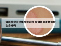 银屑病会写进体检报告吗 有银屑病皮肤体检会合格吗