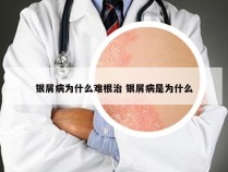 银屑病为什么难根治 银屑病是为什么