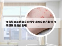 寻常型银屑病会自愈吗专注西安北方超棒 寻常型银屑病自愈吧