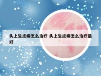 头上生皮癣怎么治疗 头上生皮癣怎么治疗最好