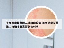牛皮癣吃甘草酸二铵肠溶胶囊 银屑病吃甘草酸二铵肠溶胶囊要多长时间