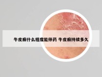 牛皮癣什么程度能停药 牛皮癣持续多久