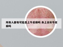 所有人都有可能患上牛皮癣吗 身上会长牛皮癣吗