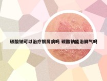 碳酸钠可以治疗银屑病吗 碳酸钠能治脚气吗