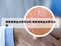 银屑病用盐水擦可以吗 银屑病用盐水擦可以吗