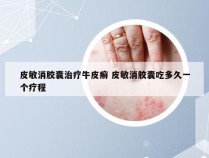 皮敏消胶囊治疗牛皮癣 皮敏消胶囊吃多久一个疗程