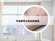 牛皮癣可以耳尖放血吗