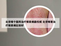 北京哪个医院治疗银屑病最权威 北京哪里治疗银屑病比较好