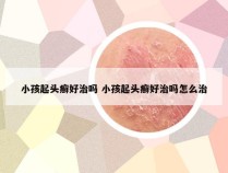 小孩起头癣好治吗 小孩起头癣好治吗怎么治
