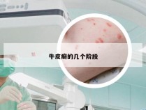 牛皮癣的几个阶段