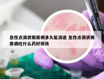 急性点滴状银屑病多久能消退 急性点滴状银屑病吃什么药好得快
