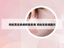 蚂蚁窝皮肤病和银屑病 蚂蚁皮肤病图片