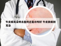 牛皮癣耳朵疼去医院还是诊所好 牛皮肤癣割耳朵