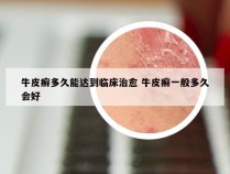 牛皮癣多久能达到临床治愈 牛皮癣一般多久会好
