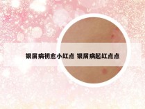 银屑病初愈小红点 银屑病起红点点