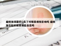 扁桃体球菌抗Q高了对银屑病有影响吗 扁桃体引起的银屑病能自愈吗