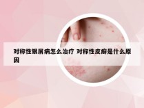 对称性银屑病怎么治疗 对称性皮癣是什么原因
