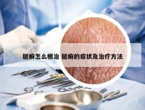 腿癣怎么根治 腿癣的症状及治疗方法