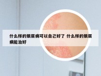 什么样的银屑病可以自己好了 什么样的银屑病能治好