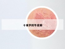 十来岁的牛皮癣