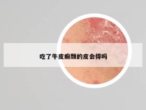 吃了牛皮癣颓的皮会得吗