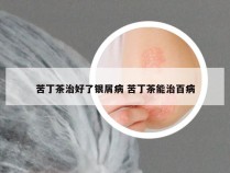 苦丁茶治好了银屑病 苦丁茶能治百病