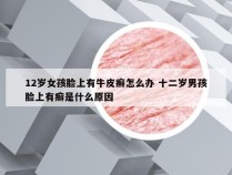 12岁女孩脸上有牛皮癣怎么办 十二岁男孩脸上有癣是什么原因
