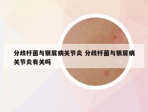 分歧杆菌与银屑病关节炎 分歧杆菌与银屑病关节炎有关吗