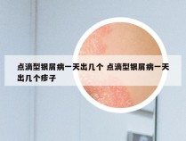 点滴型银屑病一天出几个 点滴型银屑病一天出几个疹子