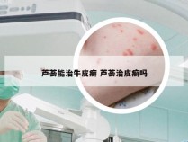 芦荟能治牛皮癣 芦荟治皮癣吗