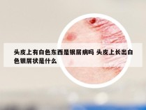 头皮上有白色东西是银屑病吗 头皮上长出白色银屑状是什么