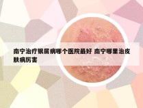 南宁治疗银屑病哪个医院最好 南宁哪里治皮肤病厉害