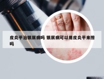 皮炎平治银屑病吗 银屑病可以用皮炎平来擦吗