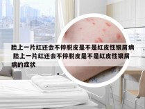 脸上一片红还会不停脱皮是不是红皮性银屑病 脸上一片红还会不停脱皮是不是红皮性银屑病的症状