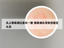 头上银屑病位置长一胞 银屑病头顶有疙瘩怎么治