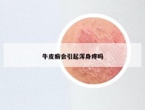 牛皮癣会引起浑身疼吗