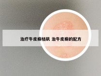 治疗牛皮癣枯矾 治牛皮癣的配方