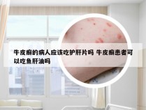 牛皮癣的病人应该吃护肝片吗 牛皮癣患者可以吃鱼肝油吗