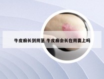 牛皮癣长到阴茎 牛皮癣会长在阴囊上吗