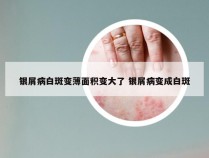 银屑病白斑变薄面积变大了 银屑病变成白斑