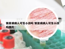 银屑病病人可生小孩吗 银屑病病人可生小孩吗图片