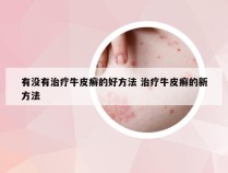 有没有治疗牛皮癣的好方法 治疗牛皮癣的新方法