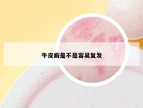 牛皮癣是不是容易复发