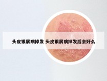 头皮银屑病掉发 头皮银屑病掉发后会好么