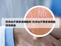 杭州治疗银屑病病医院 杭州治疗银屑病病医院有哪些
